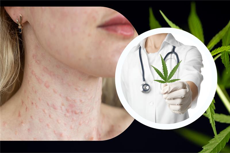 Marijuana Allergy Symptoms: Can You Be Allergic to Weed?